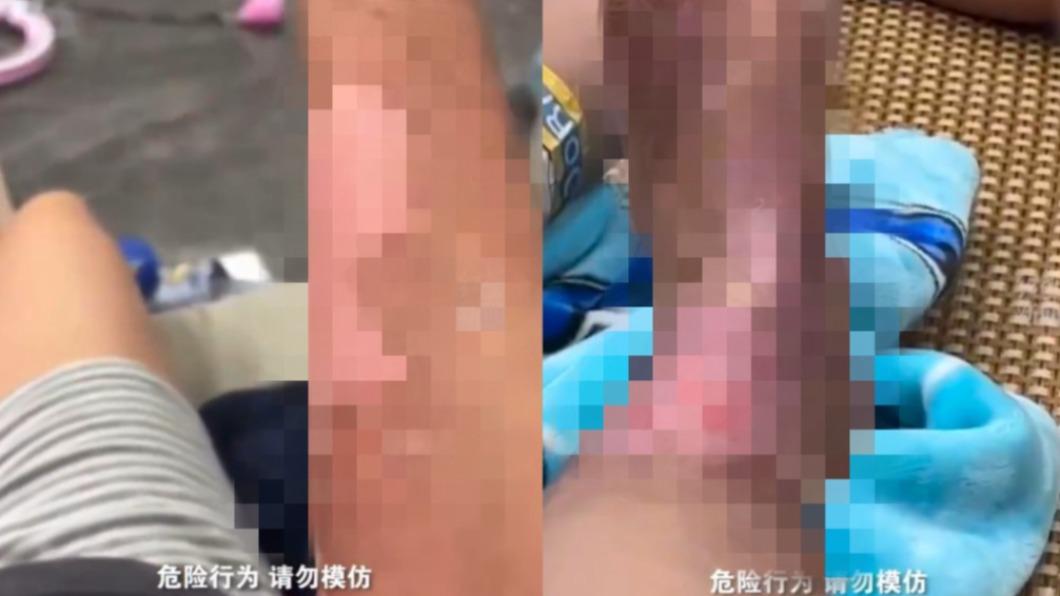 媽媽的手、腳都有大面積燒燙傷。(圖/翻攝自微博)