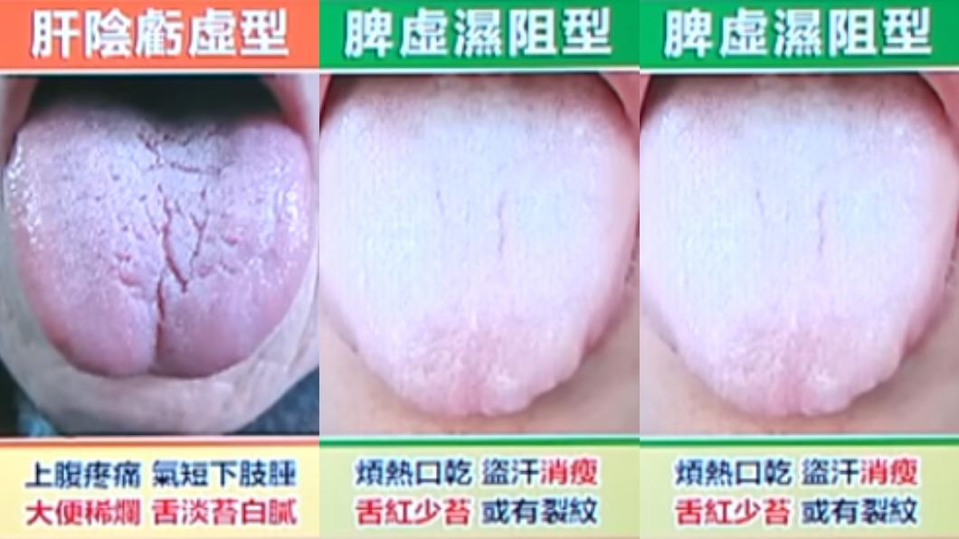 3種體質容易罹患胰臟癌。(圖/翻攝自健康2.0YouTube)