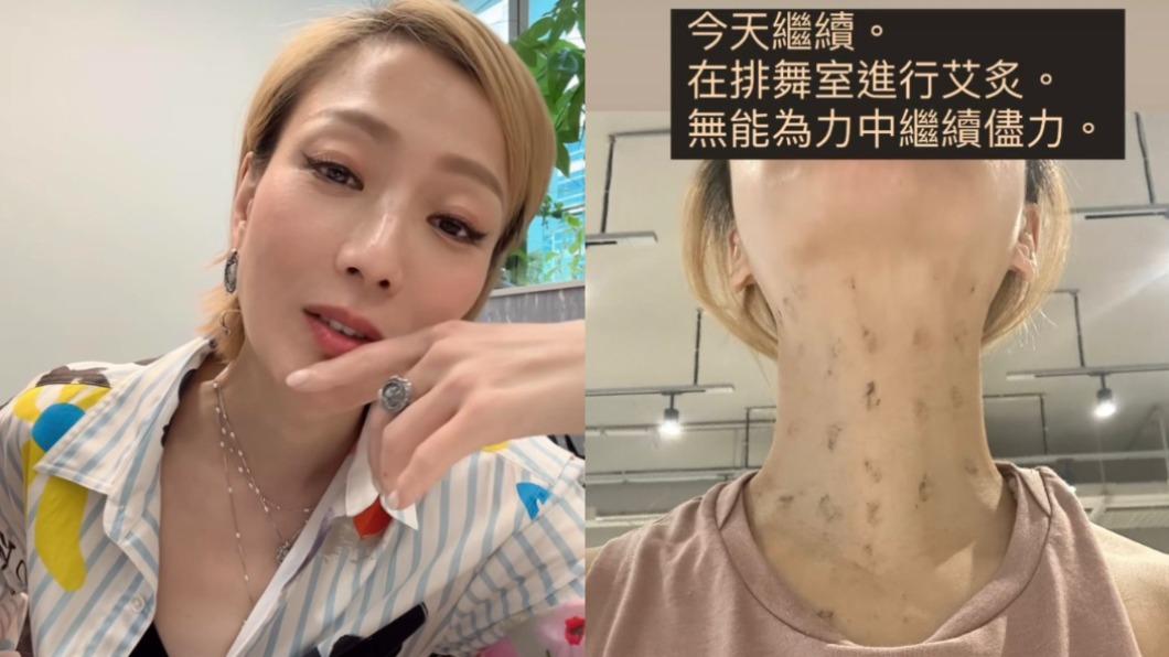 鄭秀文確診後陷入失聲危機,更透過中醫艾炙療法搶救嗓音。(圖/翻攝自鄭秀文IG)