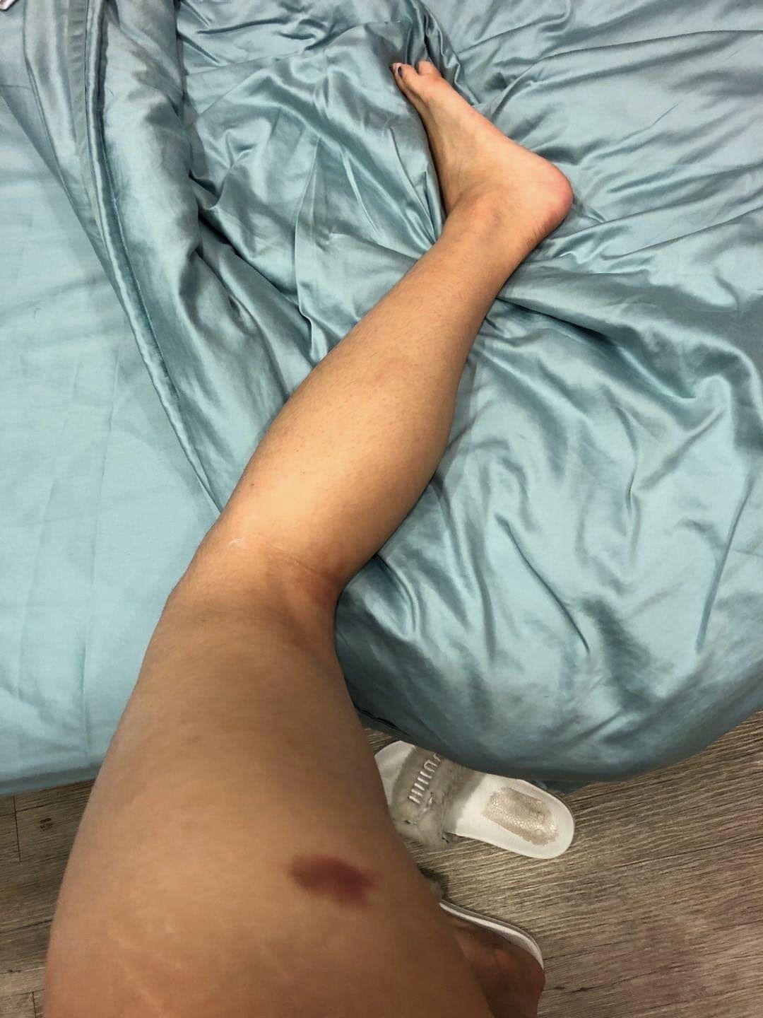 女受害者傷疤。(圖/無影無蹤授權提供)