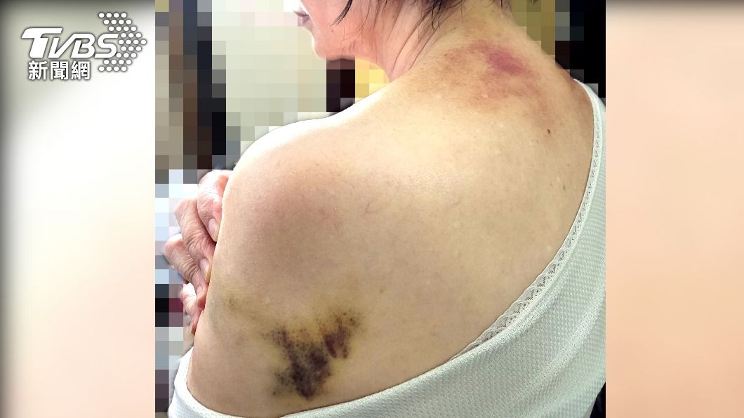 67歲的蘇女士日前因為公車急煞摔傷。（圖／蘇女士提供）