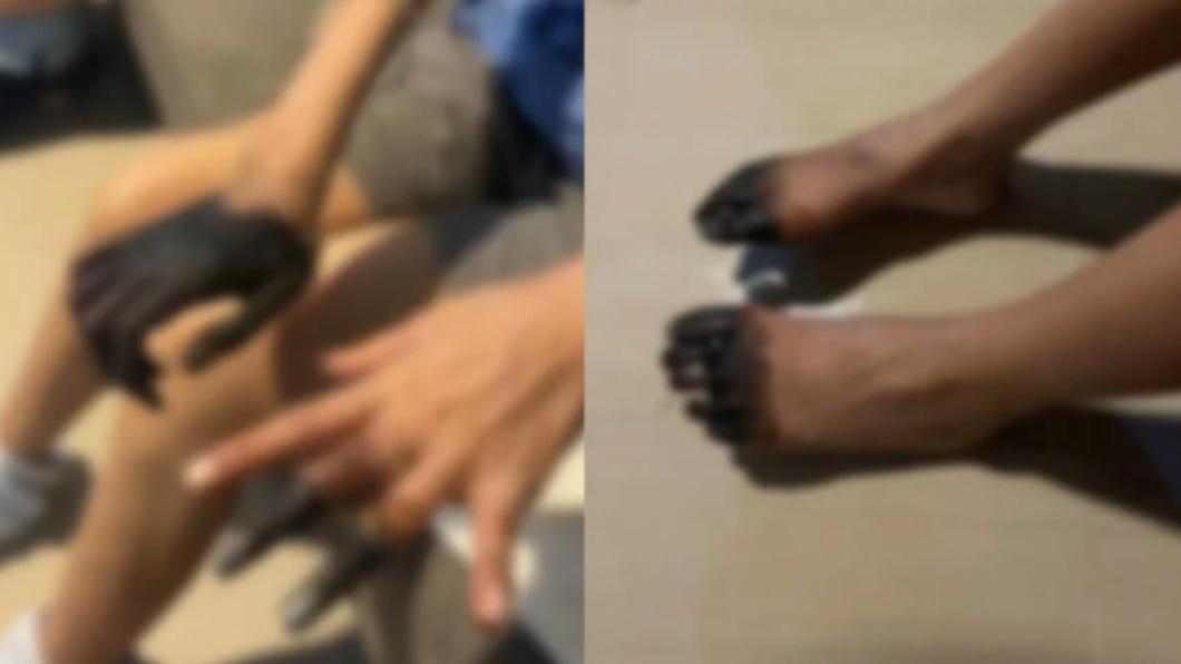嚴重腹瀉就醫 泰國女「右掌和腳趾全變黑」慘截肢