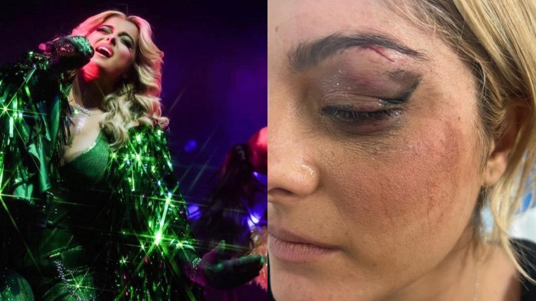 蕾克莎遭歌迷手機砸中眼睛送醫。(圖/翻攝自@beberexha IG)