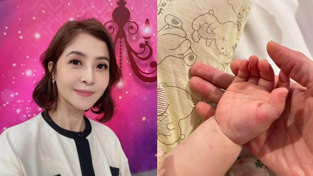 李亮瑾2寶同時高燒不退! 看醫生才知患「兒童大魔王」