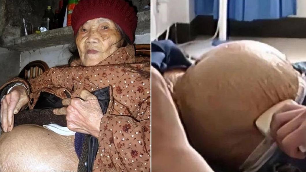 91歲嬤跌倒「查出懷孕」!X光一照「完整胎兒」 醫生也嚇壞