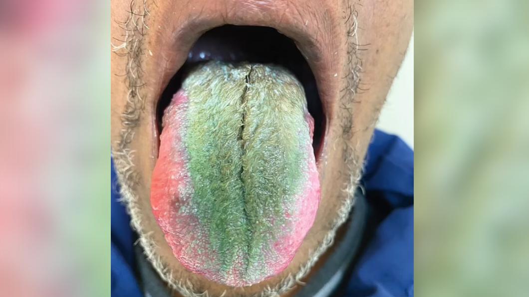 驚!男舌頭長「詭異綠毛」急求醫 竟是「這原因」導致