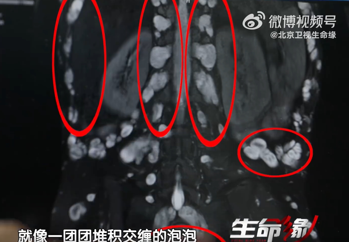 紅圈處全是腫瘤,密密麻麻長整排。(圖/翻攝自微博)