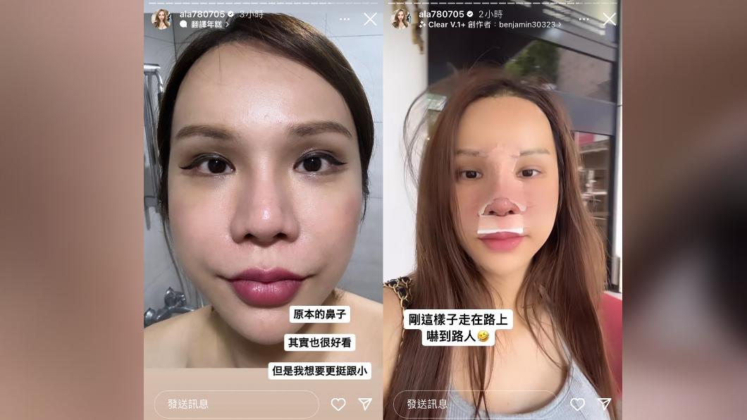 小A辣去整形鼻子。(圖/翻攝自小A辣 IG)