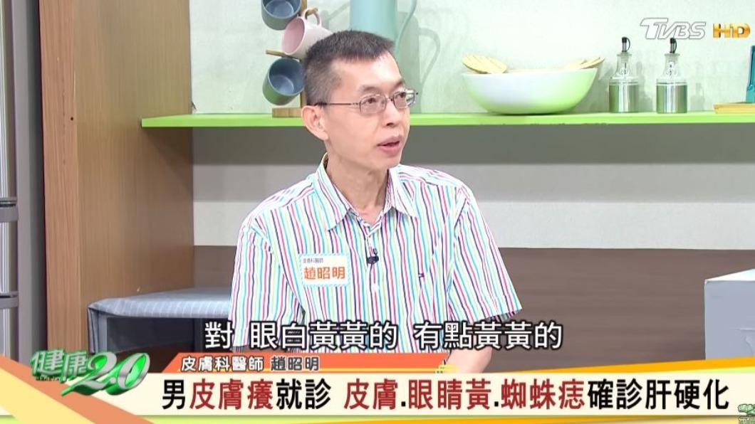 男患者除了皮膚發癢外，還有眼白泛黃、身上多處冒出蜘蛛痣的症狀。（圖／翻攝自《健康2.0》YT）