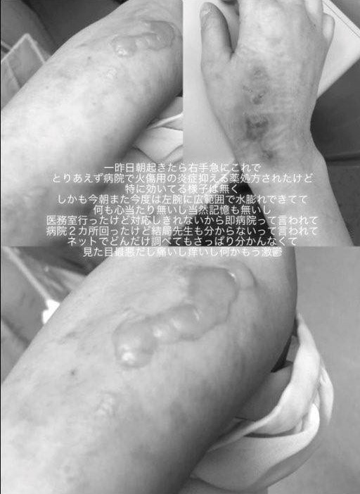 高橋知成罹罕見皮膚病,外界推測是「類天皰瘡」。(圖/高橋知成IG)