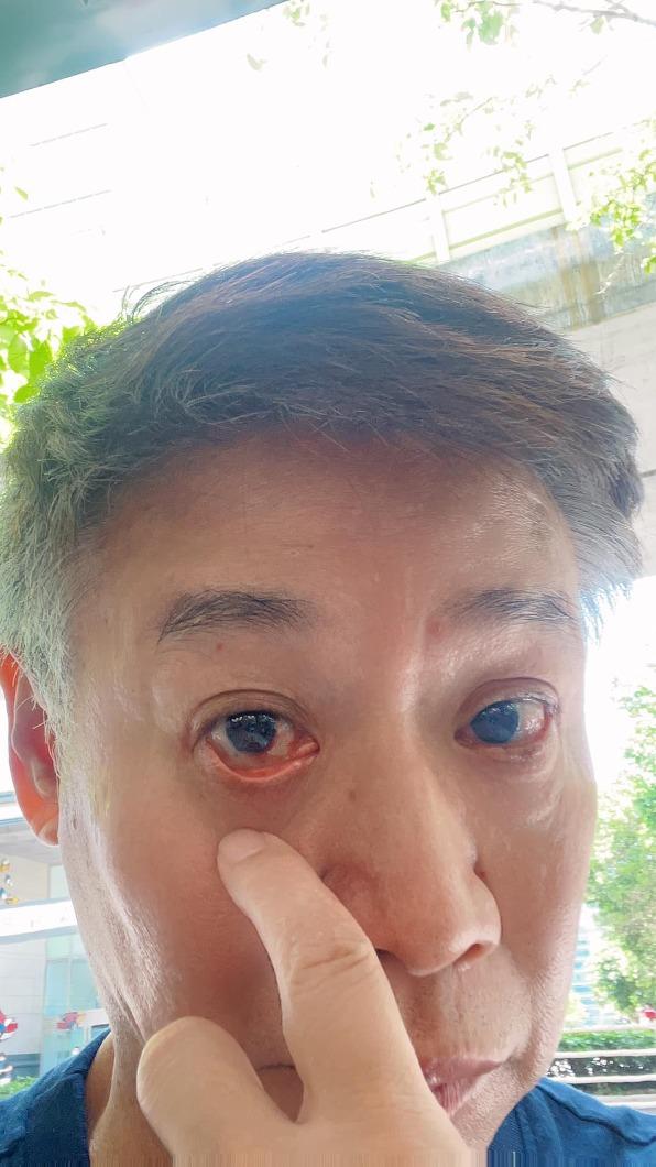 朱陸豪日前眼睛微血管破裂。(圖/翻攝自朱陸豪臉書)