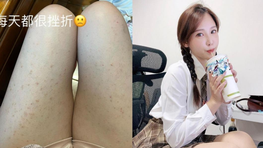 咪妃因為腿上長出顆粒,每天都很挫折。(圖/翻攝自咪妃IG)
