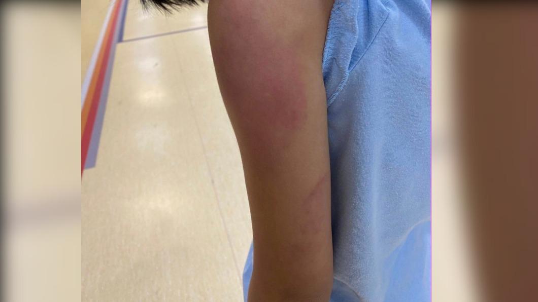 家長在臉書社團PO出女童傷勢照。指控安親班不當管教，（圖／翻攝Facebook）
