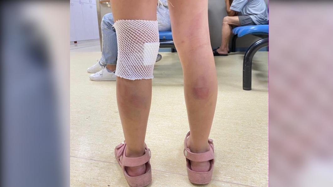 家長在臉書社團PO出女童傷勢照。指控安親班不當管教，（圖／翻攝Facebook）