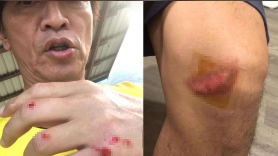 才剛慶祝父親節!吳宗憲突曬「全身多處擦傷」 傷口血淋淋畫面曝
