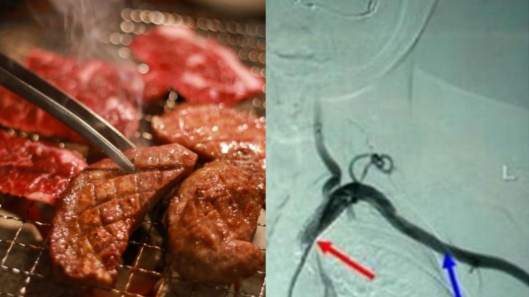 吃燒烤+1生食!嫩妹驚罹「東方美女病」 半癱送醫險喪命
