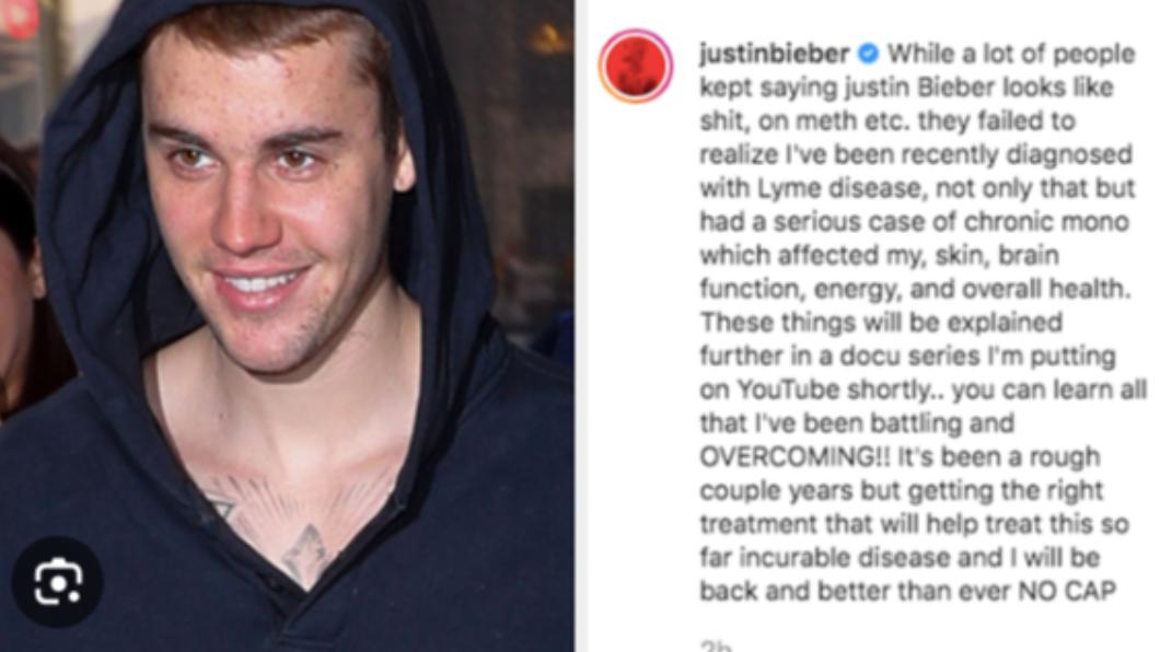 加拿大歌手小賈斯汀(Justin Bieber)也曾罹患萊姆病(Lyme disease)。(圖/翻攝自 IG)