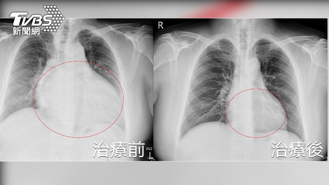 該名男子心臟比一班人大一倍。（圖／亞大附醫提供）
