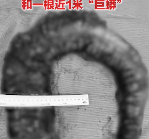 醫生取出1公尺脹大結腸。（圖／翻攝自微博）