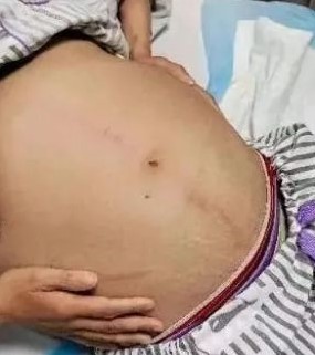 女子肚子脹到如孕婦。 （圖／翻攝自微博）