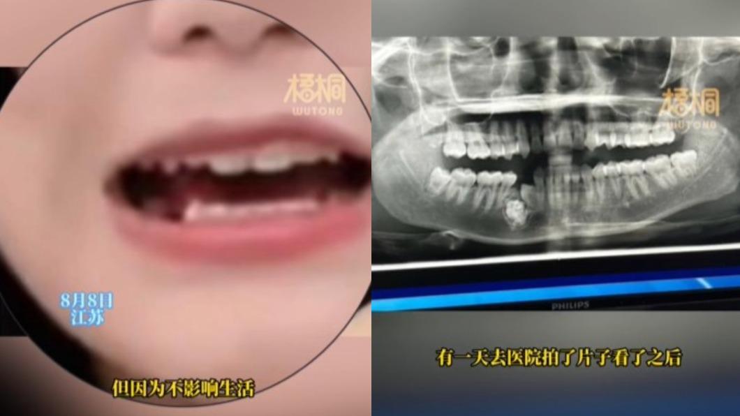 女子缺牙原因是罹患「牙瘤」。(圖/翻攝自微博《梧桐Video》)