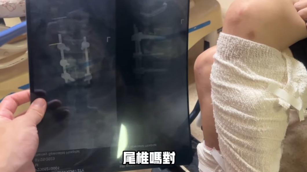 男子墜樓尾椎、小腿斷裂,半身不遂。(圖/翻攝自全球反詐騙組織GASO YouTube)