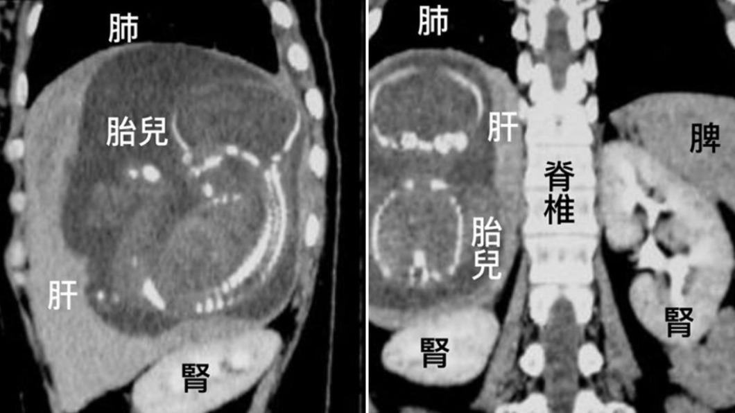 台灣醫師陳志金分享2007年越南也有起類似案例。（圖／翻攝自Icu醫生陳志金 Facebook）