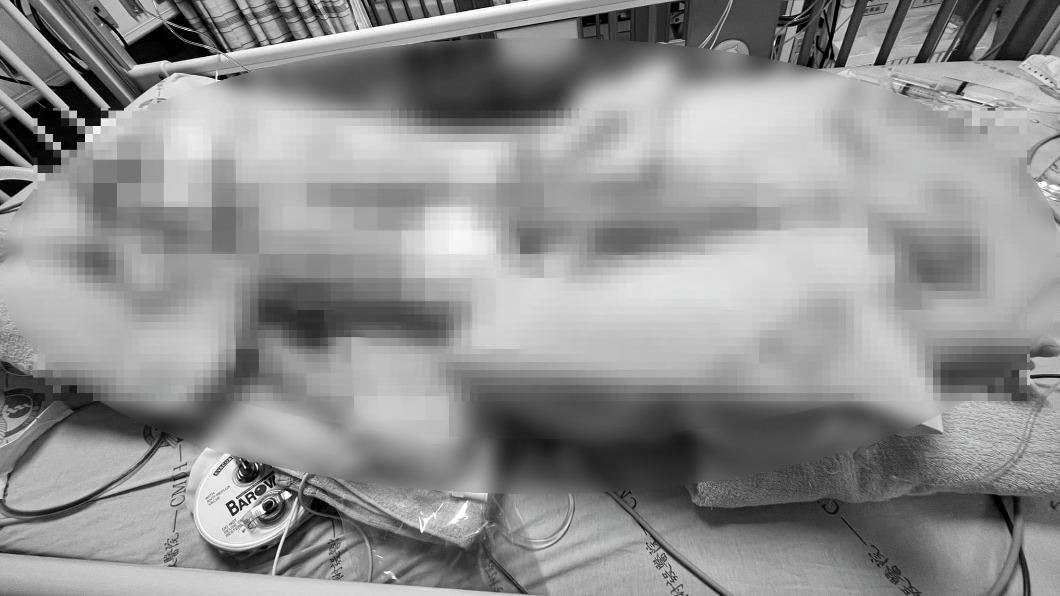 苗栗5歲童早療中心癱倒!「顱內出血」插管搶救 家屬淚求真相
