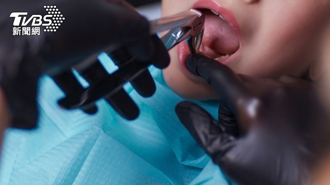 女童因蛀牙引起牙痛，經評估後決定拔牙。（示意圖／Shutterstock達志影像）