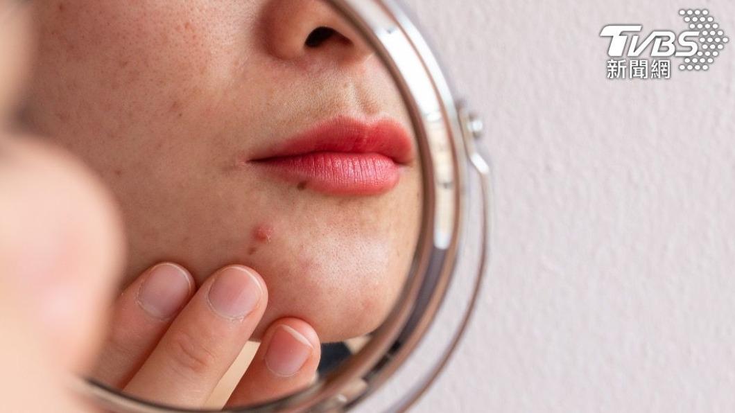 長痘位置對應不同的臟腑問題。(示意圖/shutterstock達志影像)