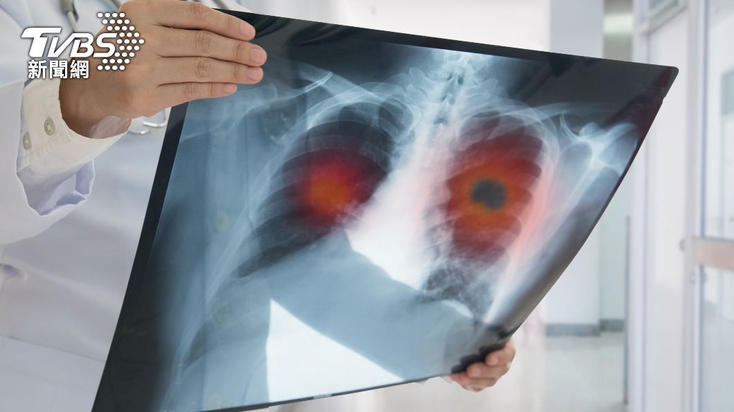醫師指出肺纖維化若未即早治療,恐怕存活不到五年。(示意圖/Shutterstock達志影像)