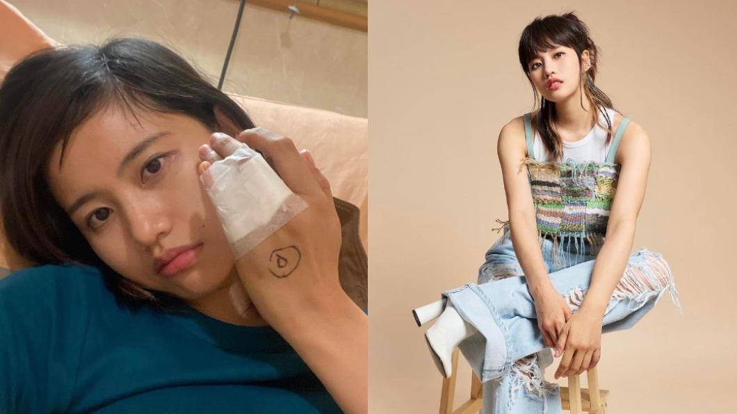 驚!女星摔斷小拇指「10字親揭最新病況」 經紀人回應了