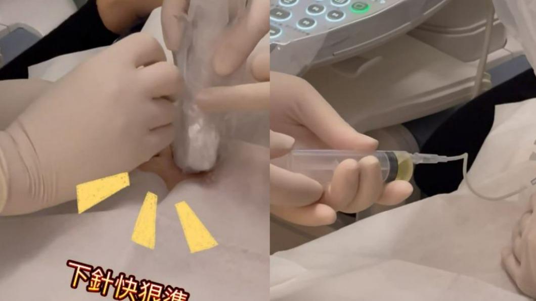 秦綾謙在臉書分享做羊膜穿刺的過程。(圖/翻攝自秦綾謙臉書)