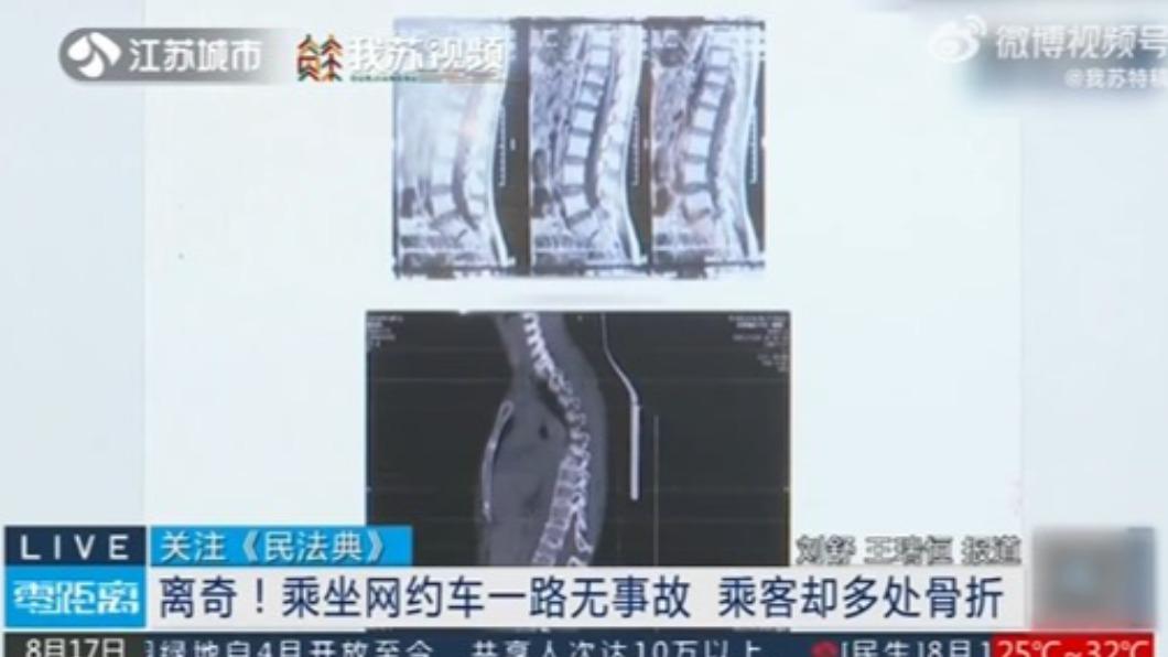 A女腰椎、胸椎都有骨折傷勢。(圖/翻攝自@我蘇特稿 微博)