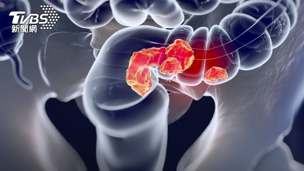 大腸癌早期無症狀較難察覺。（示意圖／Shutterstock達志影像）