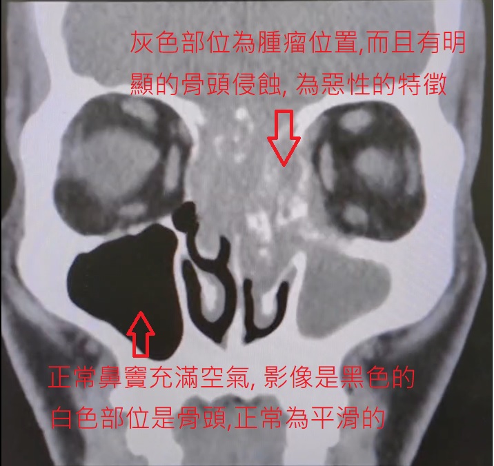 電腦斷層畫面發現腫瘤已侵蝕到骨頭。(圖/翻攝自@陳亮宇醫師 / 陳亮宇耳鼻喉科診所 臉書)