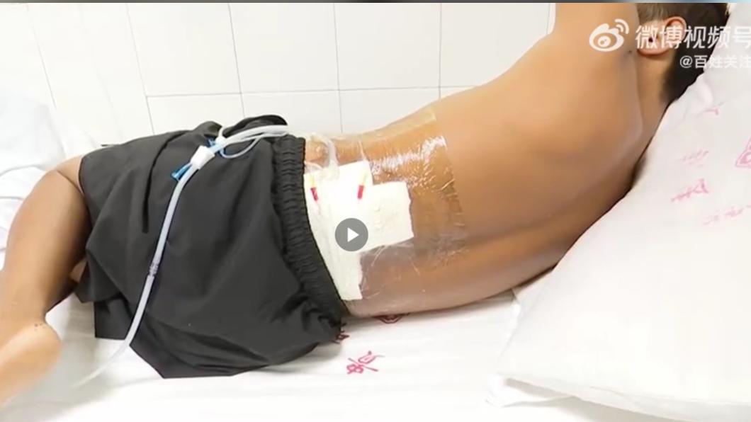 劉姓男子足、腰和臀部的傷情相當嚴重。（圖／翻攝自百姓關注微博）