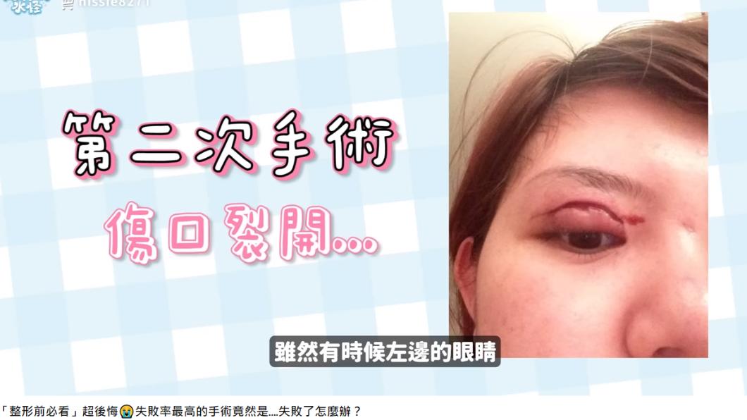 陳妮絲第二次手術傷口裂開。(圖/翻攝YouTube/Nissie陳妮絲)
