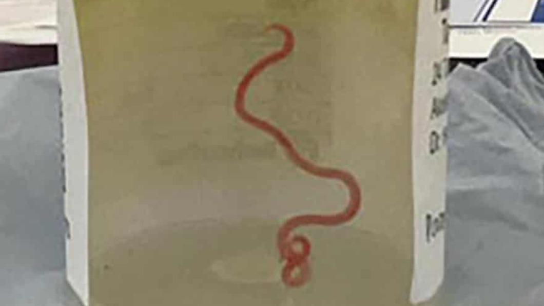 大腦藏8公分寄生蟲！澳女腹痛發燒　醫驚：夾出還在蠕動