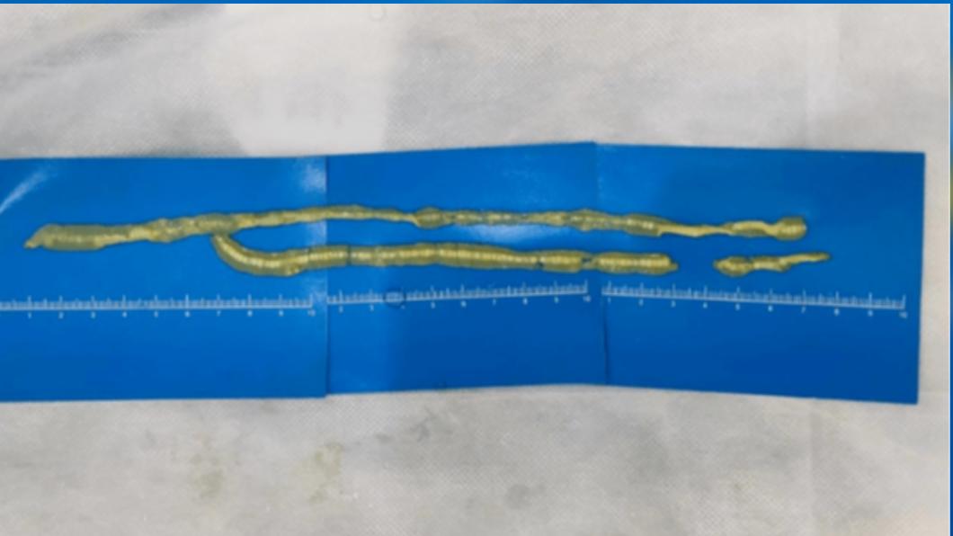 陸男愛吃生魚片照腸胃鏡發現「詭異白布條」 醫揪60公分活蟲