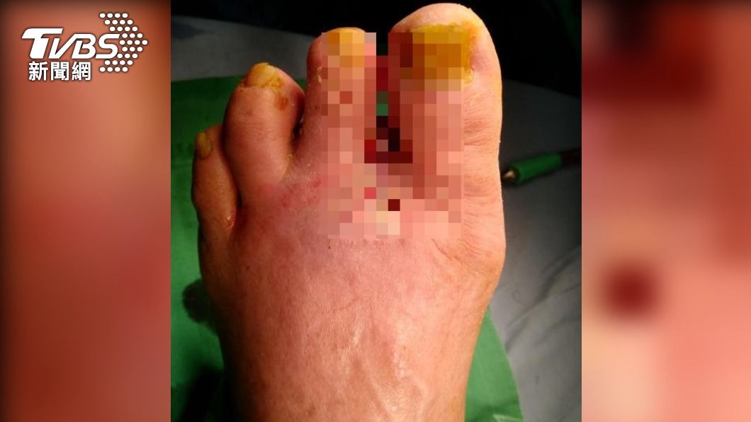 出國度假玩水染這細菌!婦人腳組織壞死 被迫「斷趾求生」