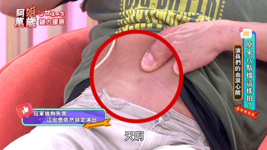 江宏恩曬出被狼犬咬的疤痕。(圖/翻攝自阿姐萬歲YT)