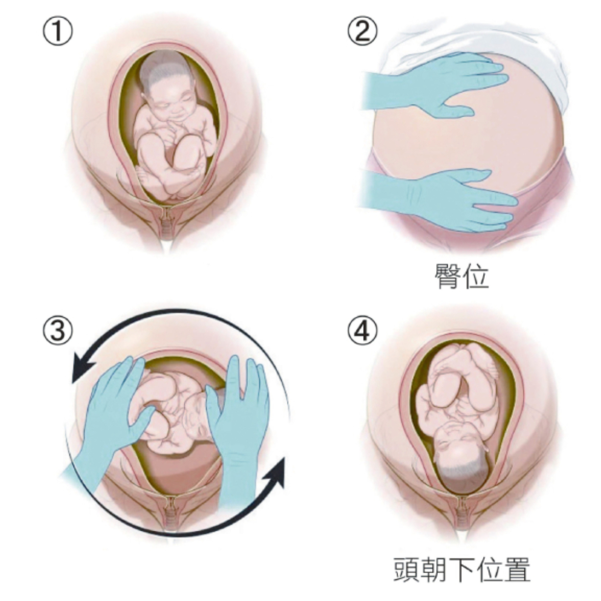胎位不正外轉術。(圖/楊濬光醫師提供)