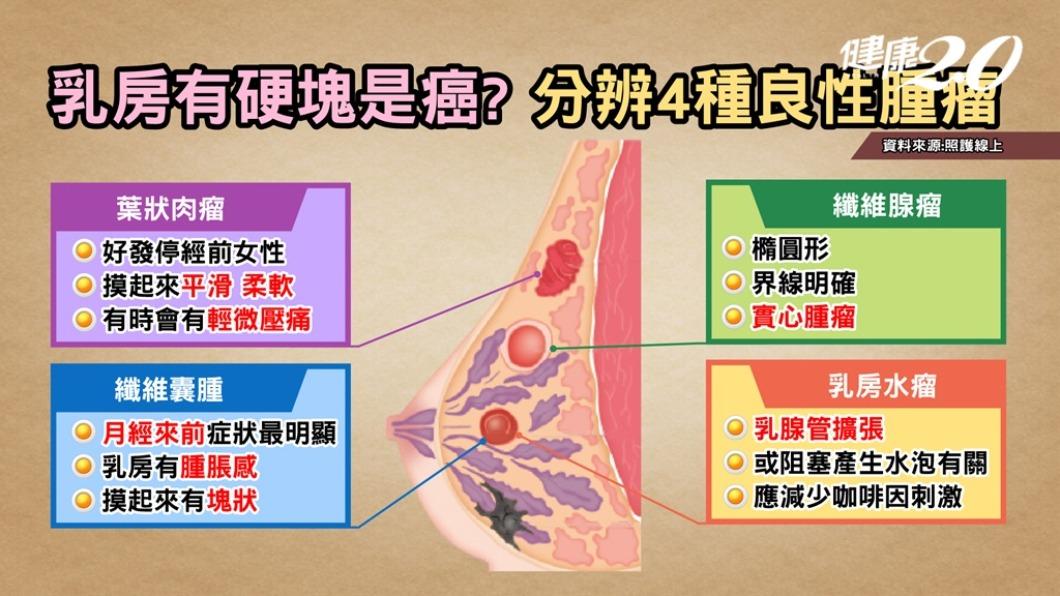 有4類的乳房腫瘤大多為良性。(圖/健康2.0)