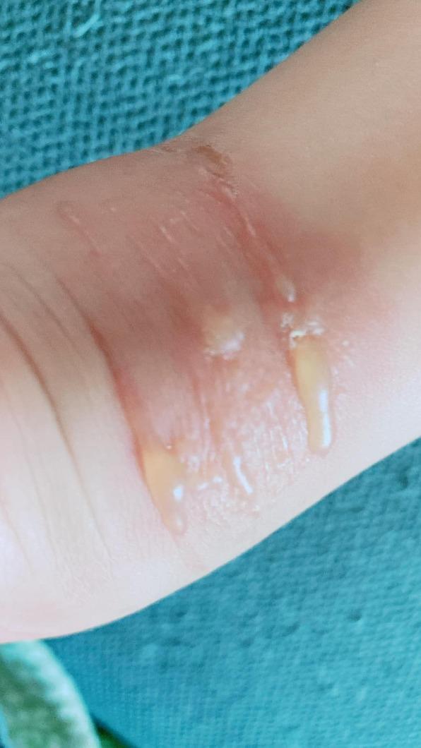 威利的腳因被膠鞋擦破皮,竟惡化成蜂窩性組織炎。(圖/翻攝自「鰻魚家家酒」臉書)