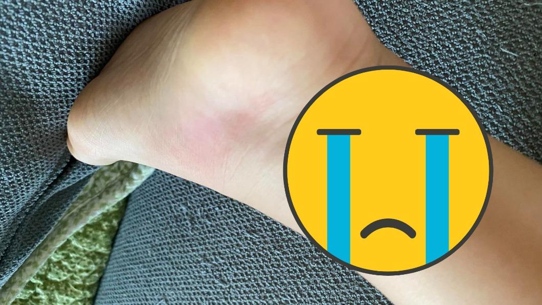 3歲童突高燒!詭異水泡連成排 凶手竟是「這款鞋」
