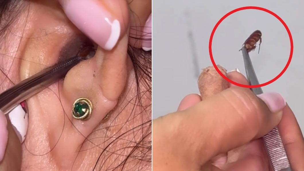 超噁!女子耳朵有啵啵聲 醫下一秒「夾出整隻蟑螂」