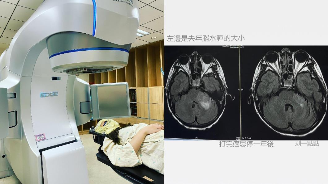 陳筱蕾曬X光照透露腦瘤從去年的3.3cm變成2.6cm。(圖/翻攝自陳筱蕾臉書)