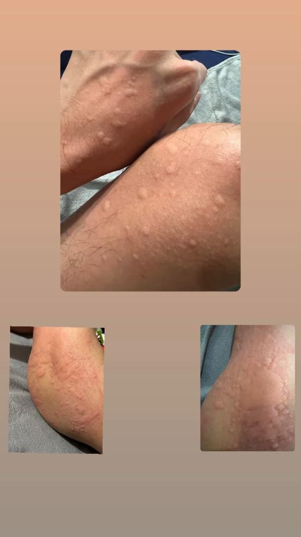 原PO在吃了螯龍蝦堡後,皮膚竟嚴重過敏,甚至還出現呼吸困難的症狀。(圖/翻攝自「爆廢公社二館」臉書)