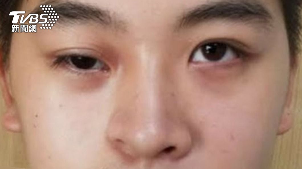不是化妝術!少年臉變形萎縮 整形外科「開眼」